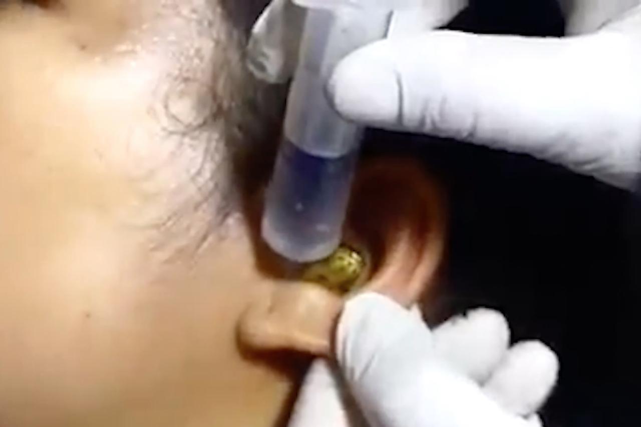 Live snake stuck in woman's ear in bizarre viral video